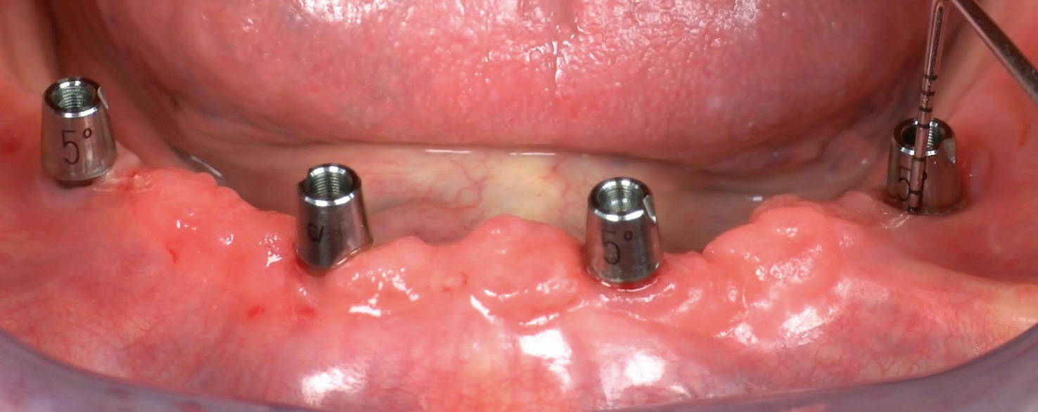 Fig. 2 One patient presented with periimplant mucositis affecting 2 implants (in positions #32 and 35). This biological complication was successfully treated with interceptive supportive therapy.