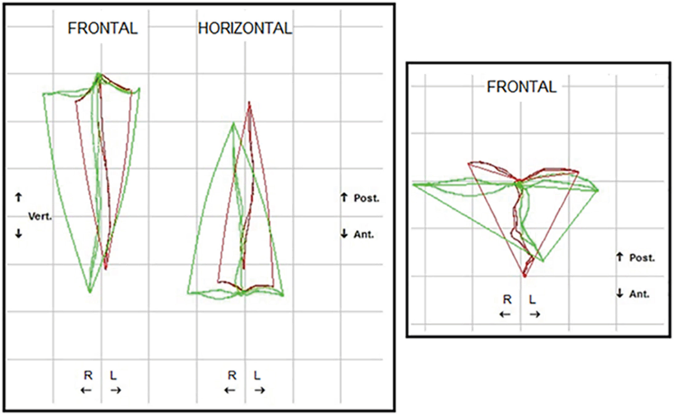 Abb. 8 Änderung des Posselt-Volumens nach PFMA-Symmetrierung.
