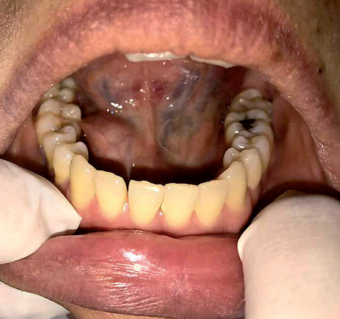 An unusual case of sublingual ranula with submandibular gland involvement DT Science